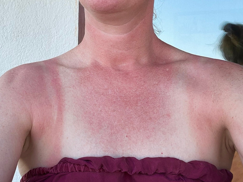 Rød og solskadet hud på bryst og skuldre efter soleksponering uden tilstrækkelig beskyttelse